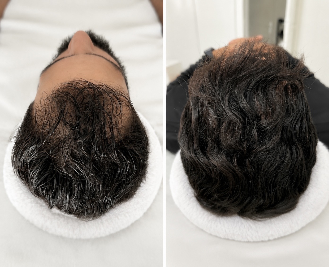 Cheveux homme brun — Hair growth