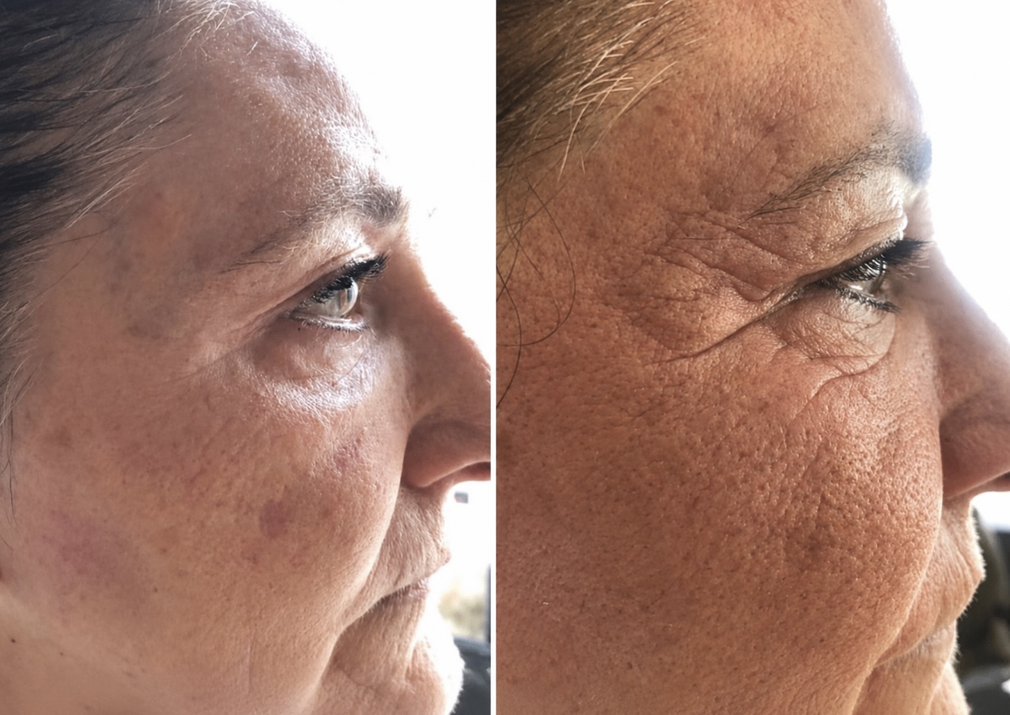 Visage — plasma lift